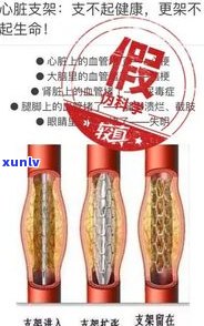 心脏支架患者能否饮用普洱茶？全解析