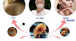 鼻窦炎喝生普洱茶有用吗？相关研究与临床实践探讨