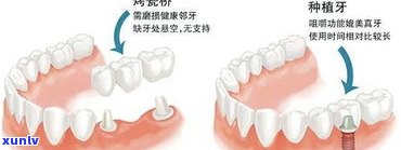 玉石可以镶牙-玉石可以镶牙吗