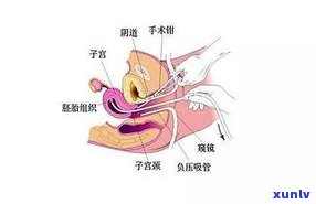 三个月可以做无痛引产手术吗？费用、风险及痛苦程度全解析