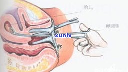 三个月可否实施无痛人流？费用多少？是不是需要引产？