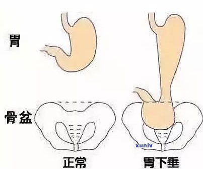 脑梗塞喝普洱茶好吗？能有效预防和改善症状吗？