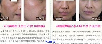 普洱茶去除黄褐斑：效果、价格及女性适用性全解析