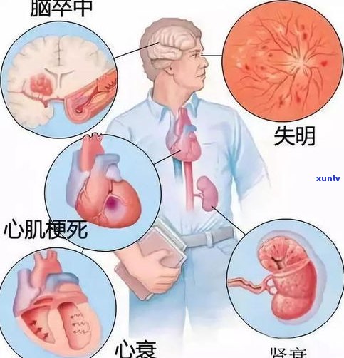 普洱茶导致血压高-普洱茶导致血压高吗